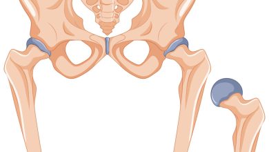 Conheça os tipos de Artroplastia de Quadril