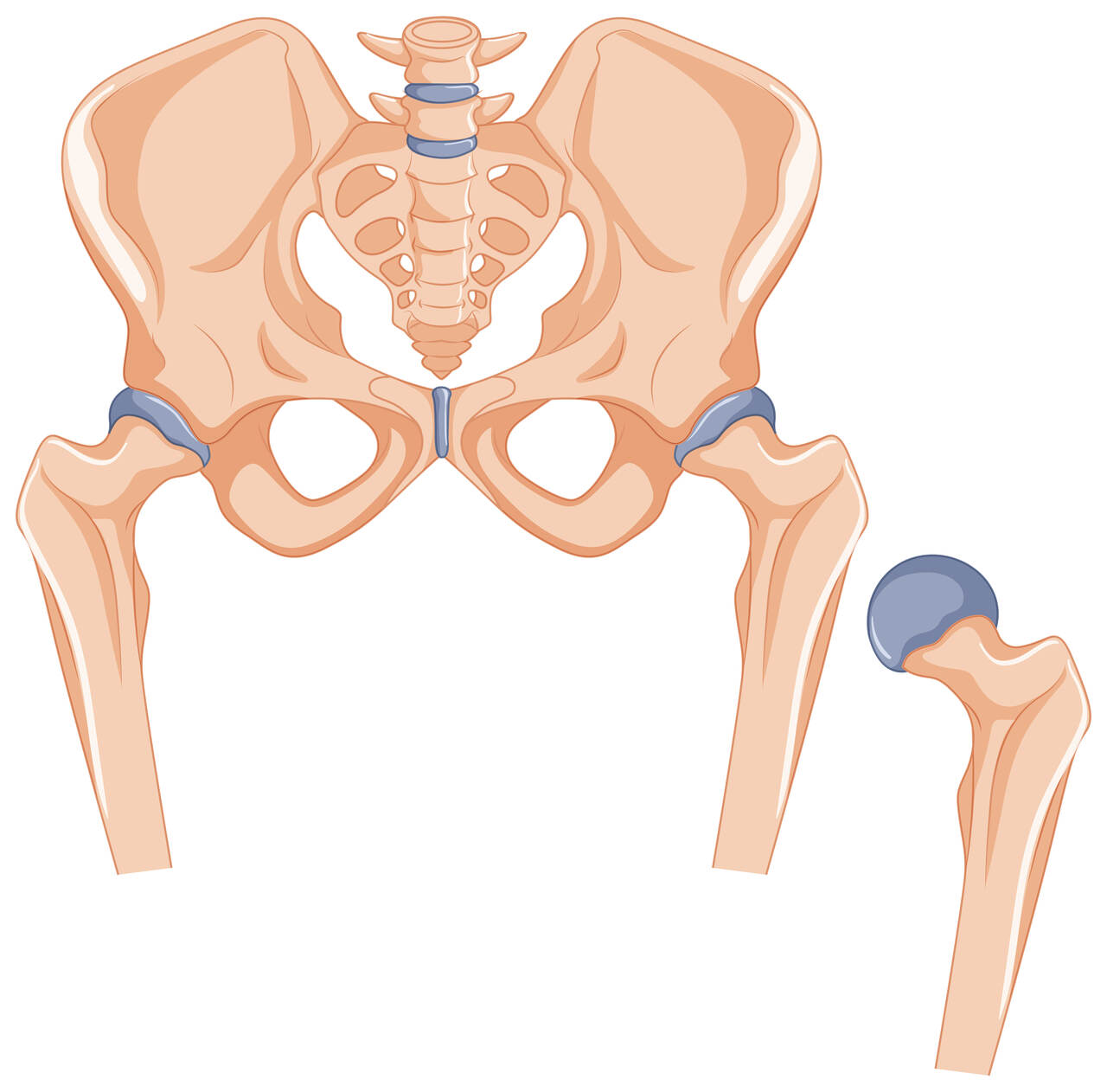 Conheça os tipos de Artroplastia de Quadril