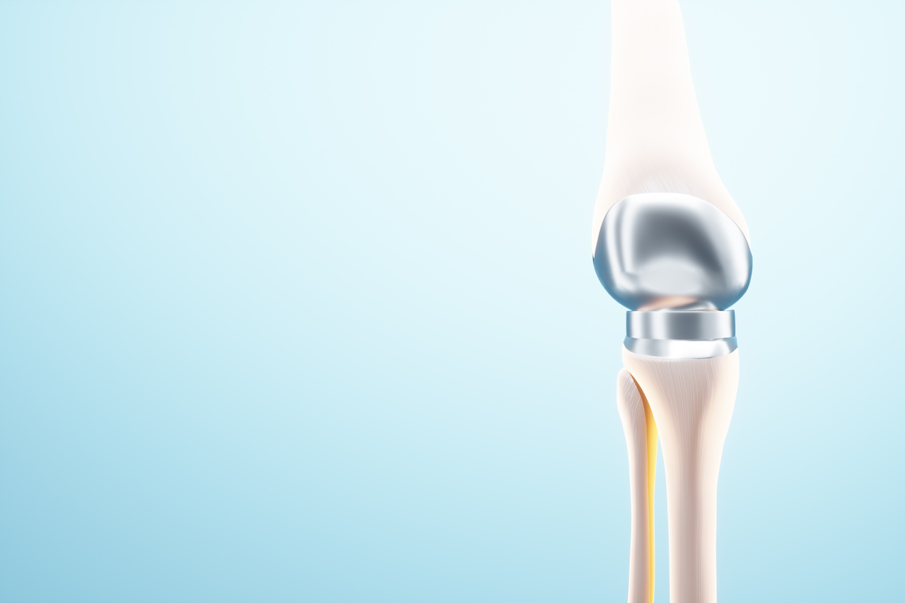 Qual a durabilidade de uma prótese de joelho?