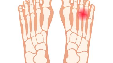 Você sabe o que é o neuroma de morton